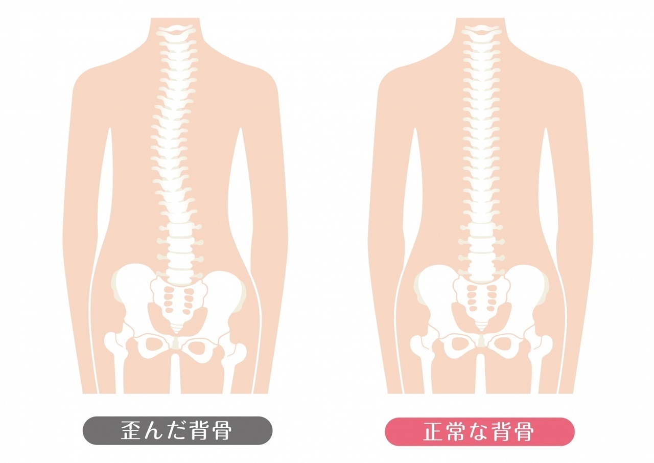 歪んだ背骨と正常な背骨