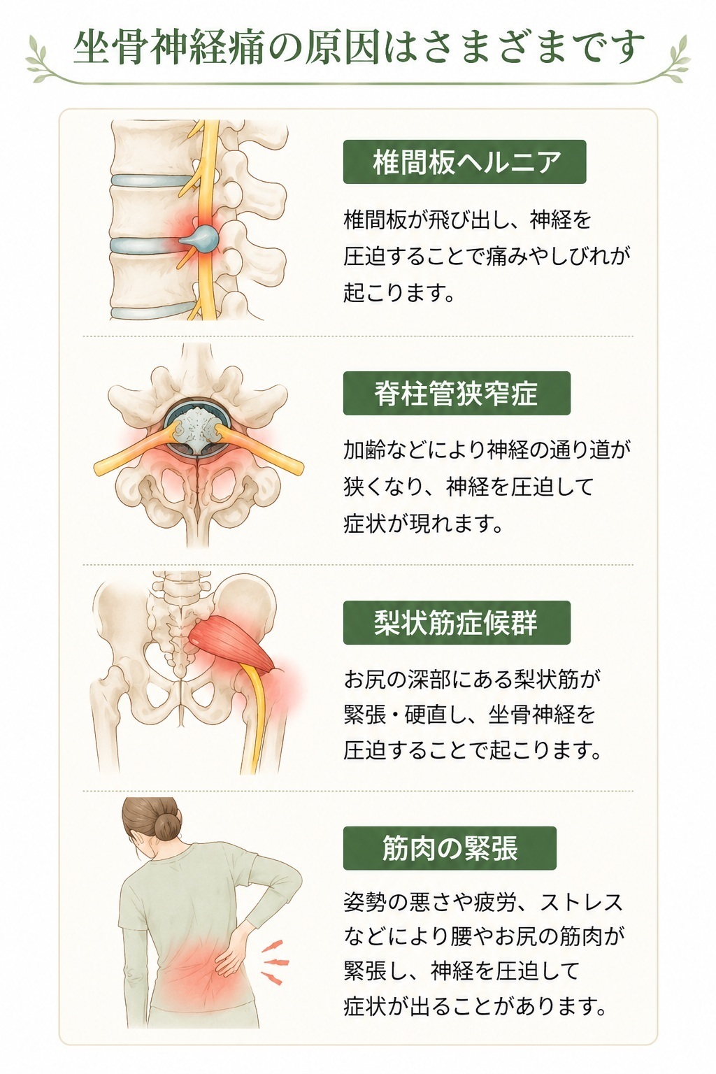 坐骨神経痛の原因を説明するイラスト